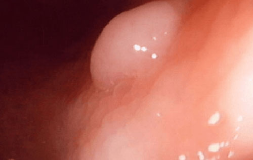 Hình ảnh polyp hậu môn giai đoạn đầu