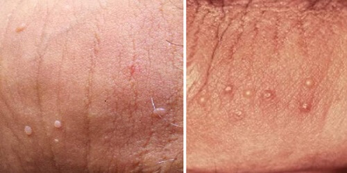 Hình ảnh bệnh sùi mào gà giai đoạn đầu ở nam, nữ giới    