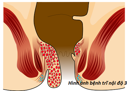 Hình ảnh minh họa bệnh trĩ nội độ 3
