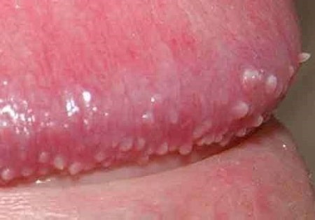 Cách nhận diện hình ảnh mụn gai sinh dục
