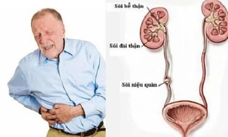 Nguyên nhân gây xuất hiện hình ảnh viêm niệu đạo ở nam giới