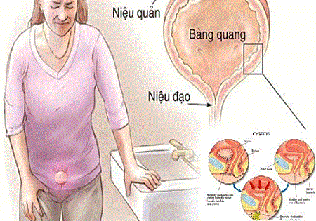 Hình ảnh viêm niệu đạo nữ giới như nào ?