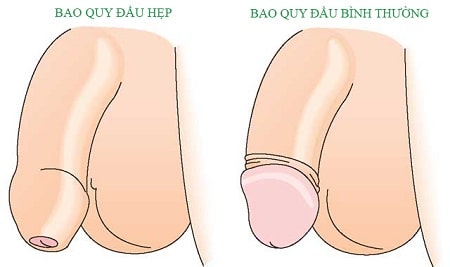 Hẹp bao quy đầu là gì ?
