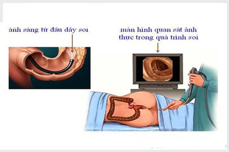 Liệu khám trĩ có cần nội soi không?