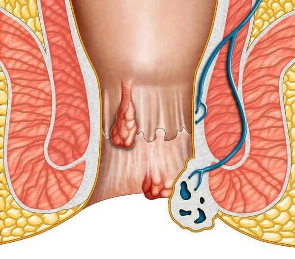 Một số thông tin quan trọng về bệnh trĩ