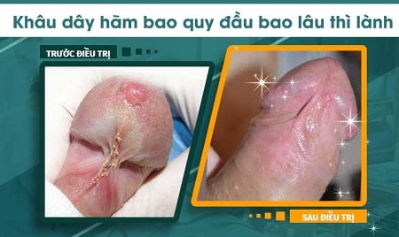 [Giải đáp] Khâu dây hãm bao quy đầu bao lâu thì lành?
