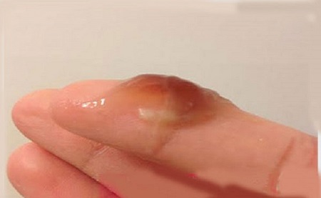 Khí hư có màu nâu đỏ là bệnh lý