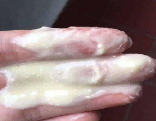 Khí hư màu trắng đục như bã đậu