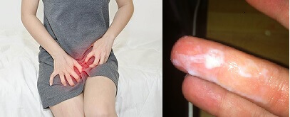 Khí hư màu trắng đục và ngứa 