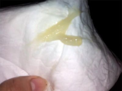 Khí hư ra màu xanh nhưng không mùi để lâu có sao không?