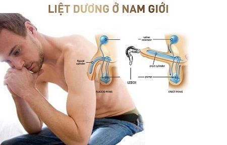 Liệt dương là bệnh gì?