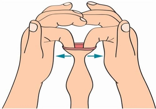 Lột bao quy đầu tại nhà ở người lớn