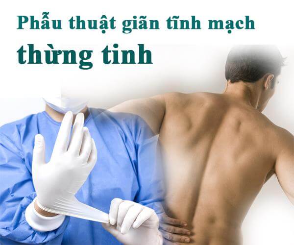 Mổ giãn tĩnh mạch thừng tinh bao nhiêu tiền?