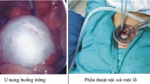 Mổ nội soi u nang buồng trứng
