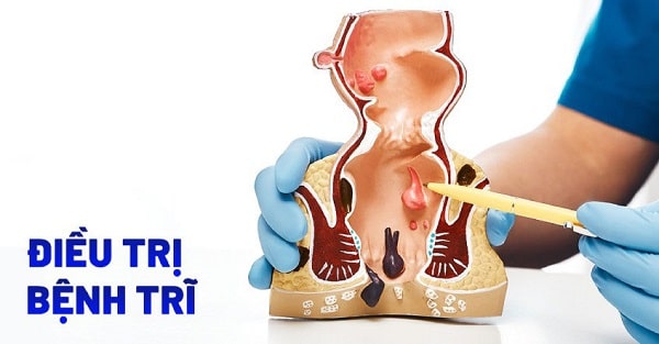 Mổ trĩ nội bao lâu thì lành phụ thuộc vào phương pháp điều trị 