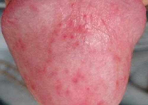 Mọc mụn đỏ ở bao quy đầu – Biểu hiện viêm bao quy đầu