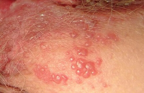 Mọc mụn ở vùng kín nam giới
