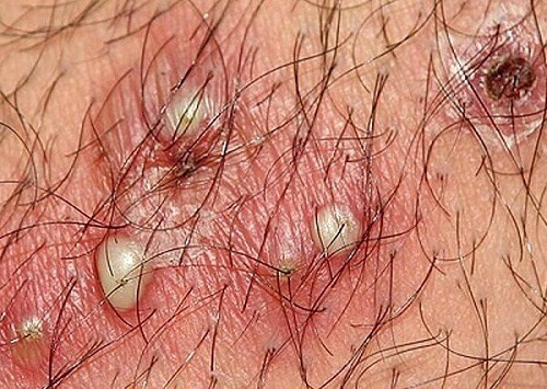 Hình ảnh nổi mụn ở vùng kín nữ
