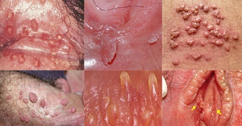 Hình ảnh mụn vùng kín