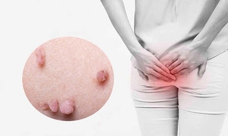 Mụn thịt mọc gần hậu môn là gì ?