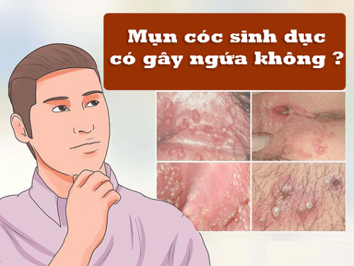  Mụn cóc sinh dục có ngứa không?