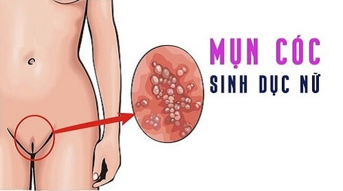 Hình ảnh mụn cóc sinh dục ở nữ