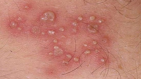 Bị mụn rộp sinh dục có nguy hiểm không ?