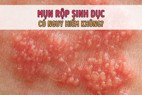 Bị bệnh mụn rộp sinh dục có nguy hiểm không?