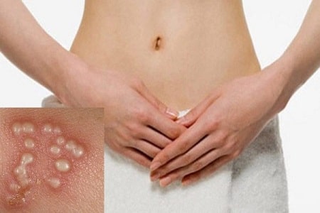 Dấu hiệu bệnh mụn rộp sinh dục giai đoạn đầu