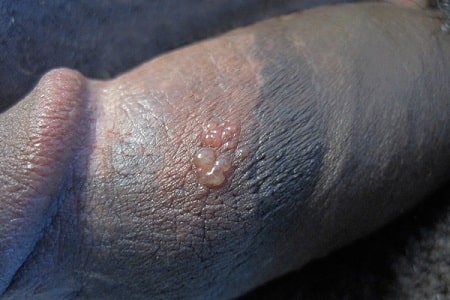 Bệnh mụn rộp sinh dục có nguy hiểm không?