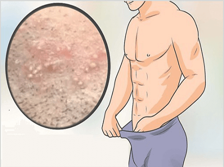 Biện pháp phòng tránh mụn rộp sinh dục ở bao quy đầu