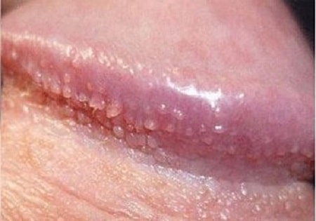Mụn rộp sinh dục ở bao quy đầu xuất hiện như thế nào?