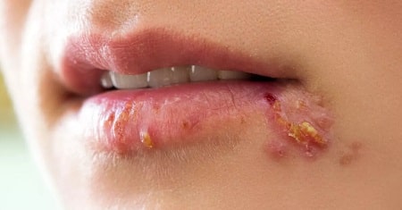 Nguyên nhân nào dẫn đến bệnh mụn rộp sinh dục ở môi