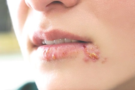 Mụn rộp sinh dục ở môi là bệnh gì?