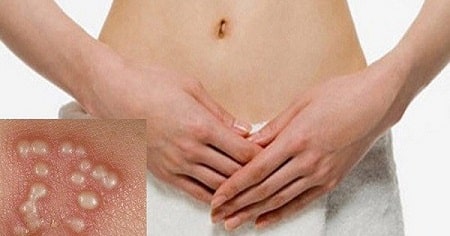 Bệnh mụn rộp sinh dục ở nữ có nguy hiểm không?