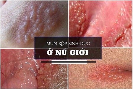 Bệnh mụn rộp sinh dục ở nữ là như thế nào?