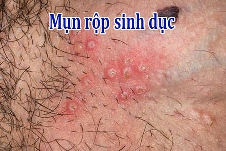 Nguyên nhân mụn rộp sinh dục tại vùng kín