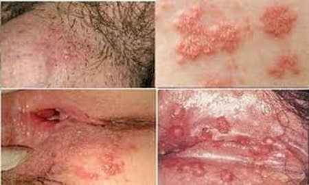 Tìm hiểu về bệnh mụn rộp sinh dục tại vùng kín