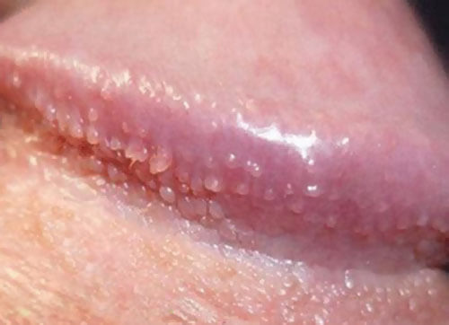 Mụn trắng dưới bao quy đầu – Dấu hiệu chuỗi hạt ngọc dương vật