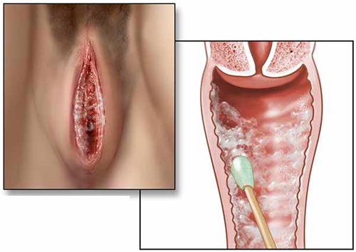 Nấm candida ở phụ nữ