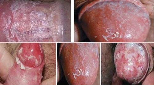 Hình ảnh nấm dương vật