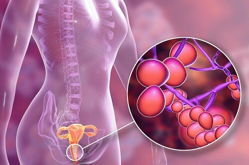 Nấm sinh dục ở nữ giới