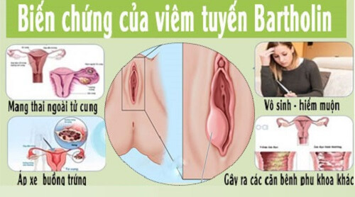 Biến chứng của viêm tuyến bartholin