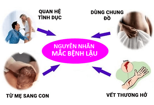 Nguyên nhân bị lậu ở nam giới