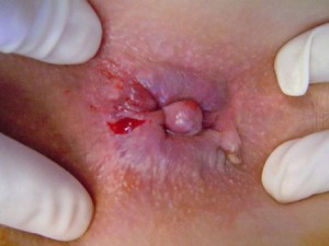 Bị sưng gần hậu môn – Dấu hiệu bệnh trĩ