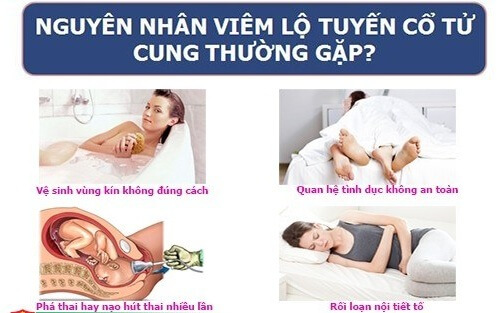 Nguyên nhân gây viêm lộ tuyến cổ tử cung