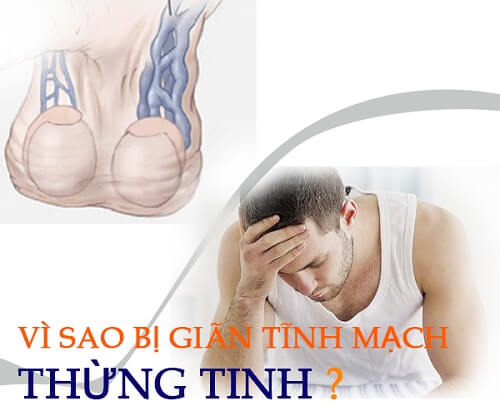 Nguyên nhân giãn tĩnh mạch thừng tinh