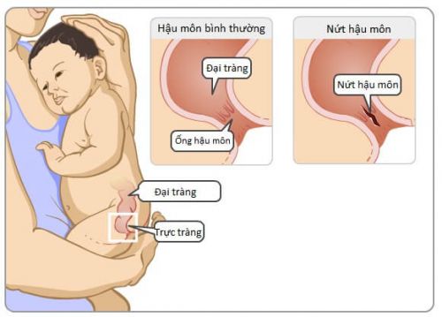 nguyên nhân nứt kẽ hậu môn ở trẻ