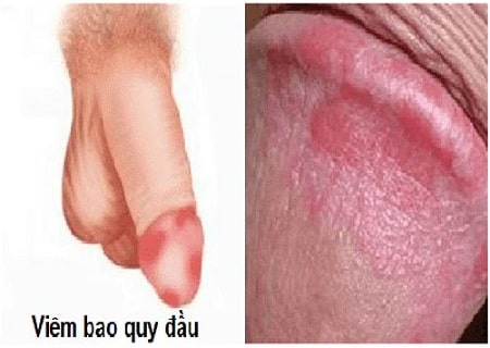 Triệu chứng và hình ảnh viêm bao quy đầu ở nam giới 