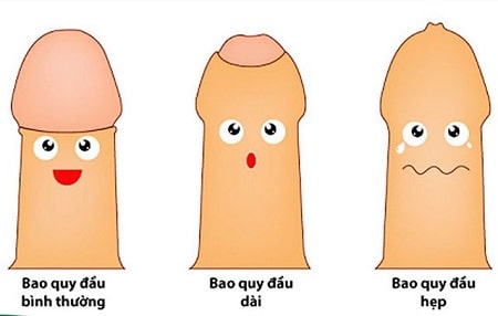 Nguyên nhân gây viêm hẹp bao quy đầu -  Dài/ hẹp bao quy đầu 